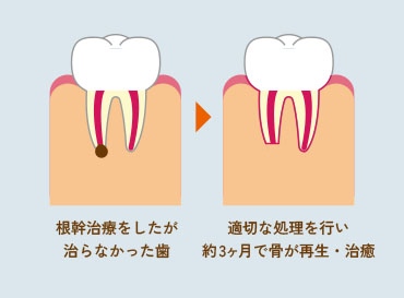 根幹治療をしたが治らなかった歯 適切な処理を行い役３ヶ月で骨が再生・治療