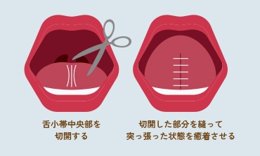 舌小帯中央部を切開する 切開した部分を縫って突破った状態を療着させる