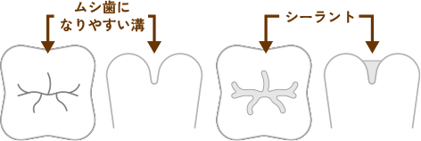 虫歯になりやすい歯の溝（シーラント）